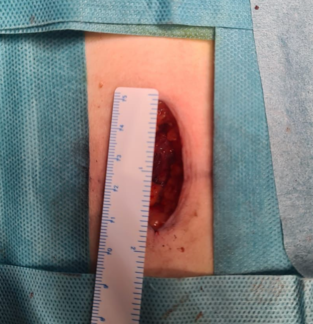 Cirugía Mínimamente Invasiva de Columna en Barcelona