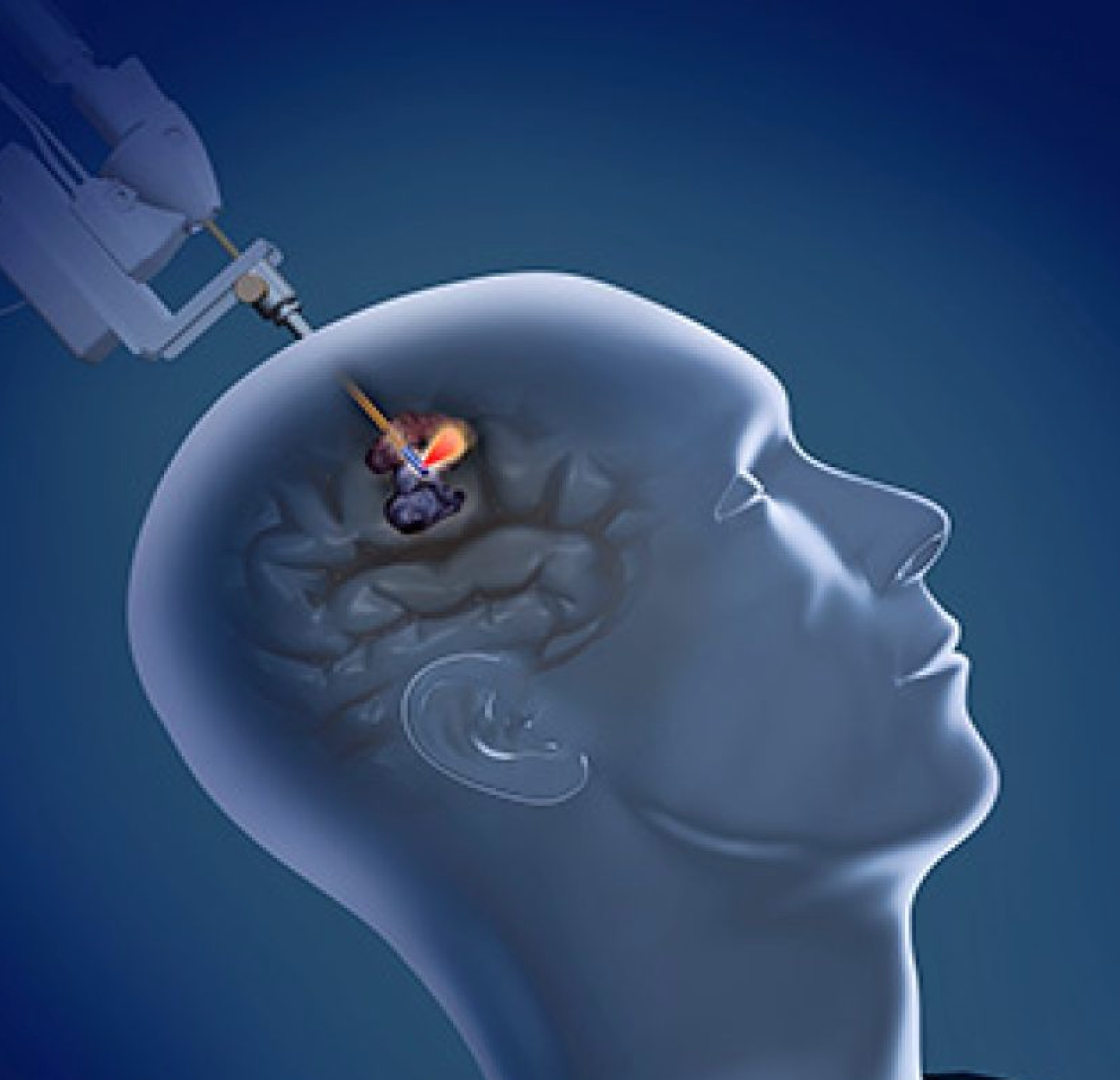 endoscopia cerebral en Barcelona