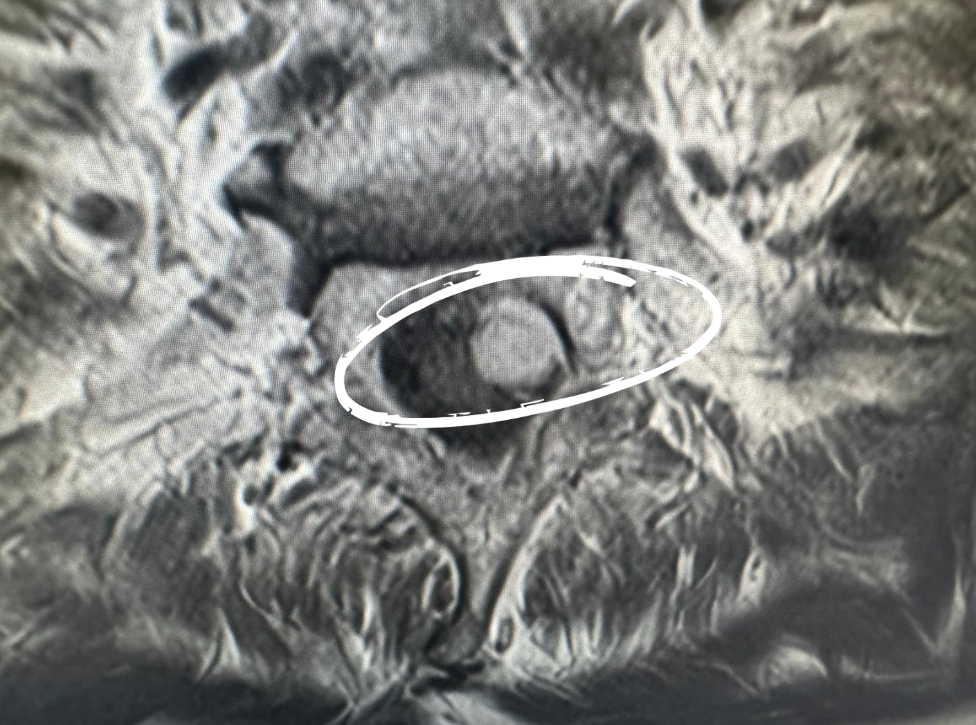 tumor cervical en barcelona