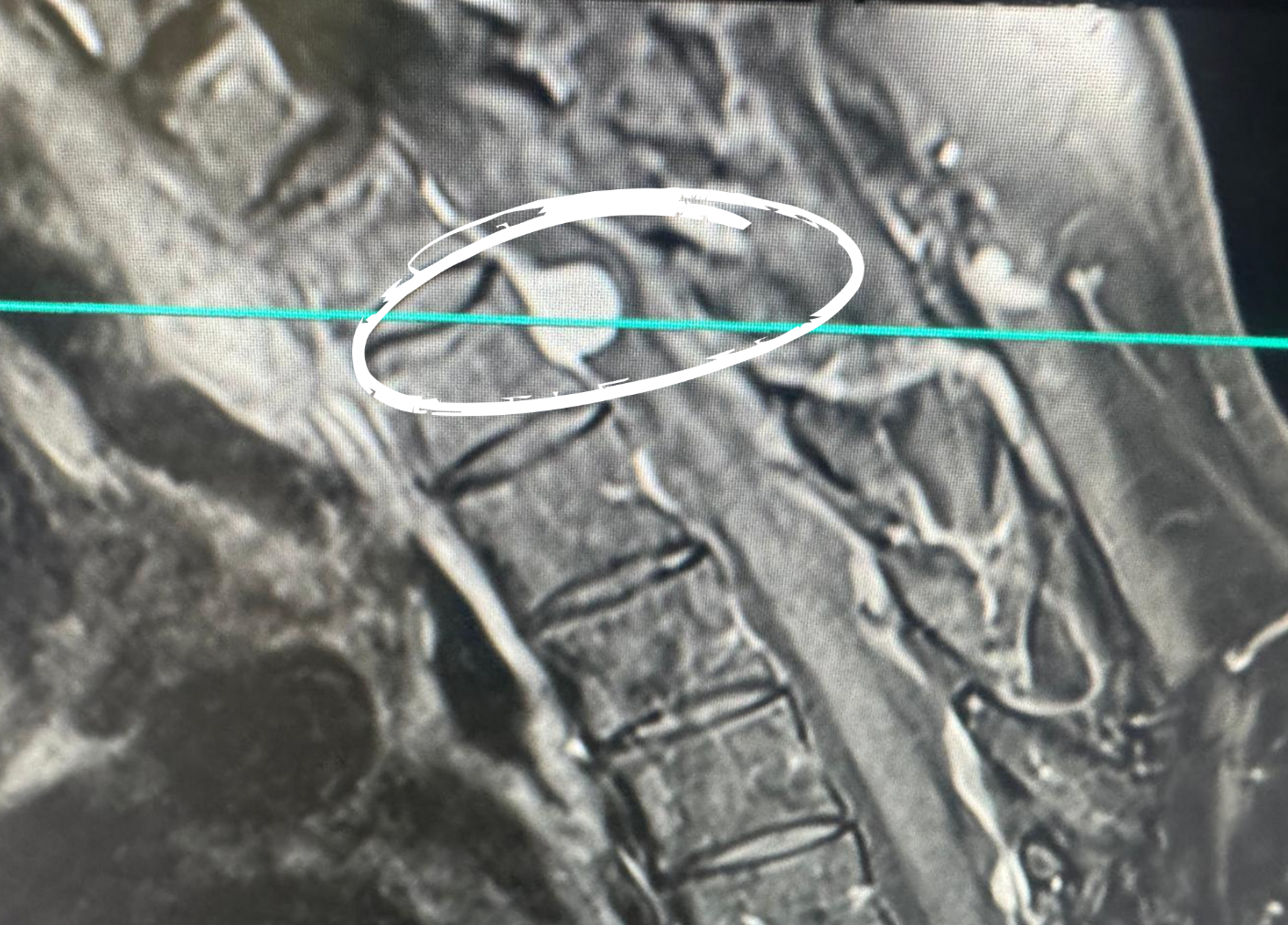 tumor cervical en barcelona