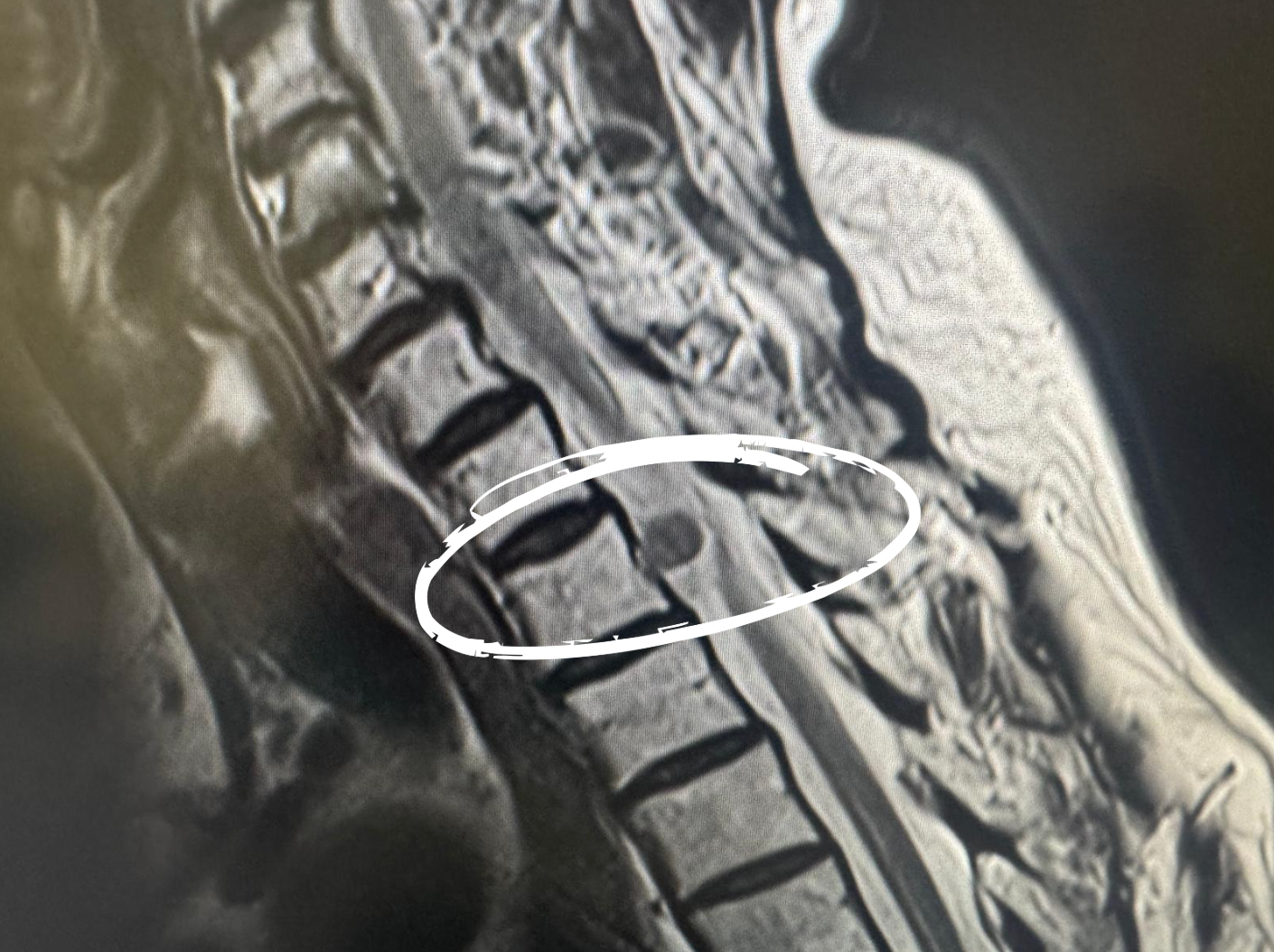tumor cervical en barcelona