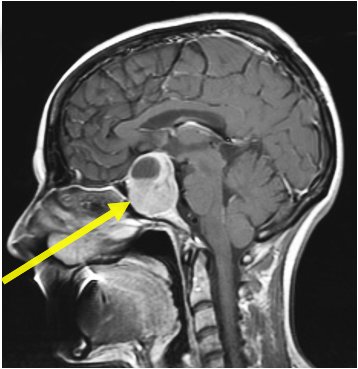 Tumor en la hipófisis en Barcelona