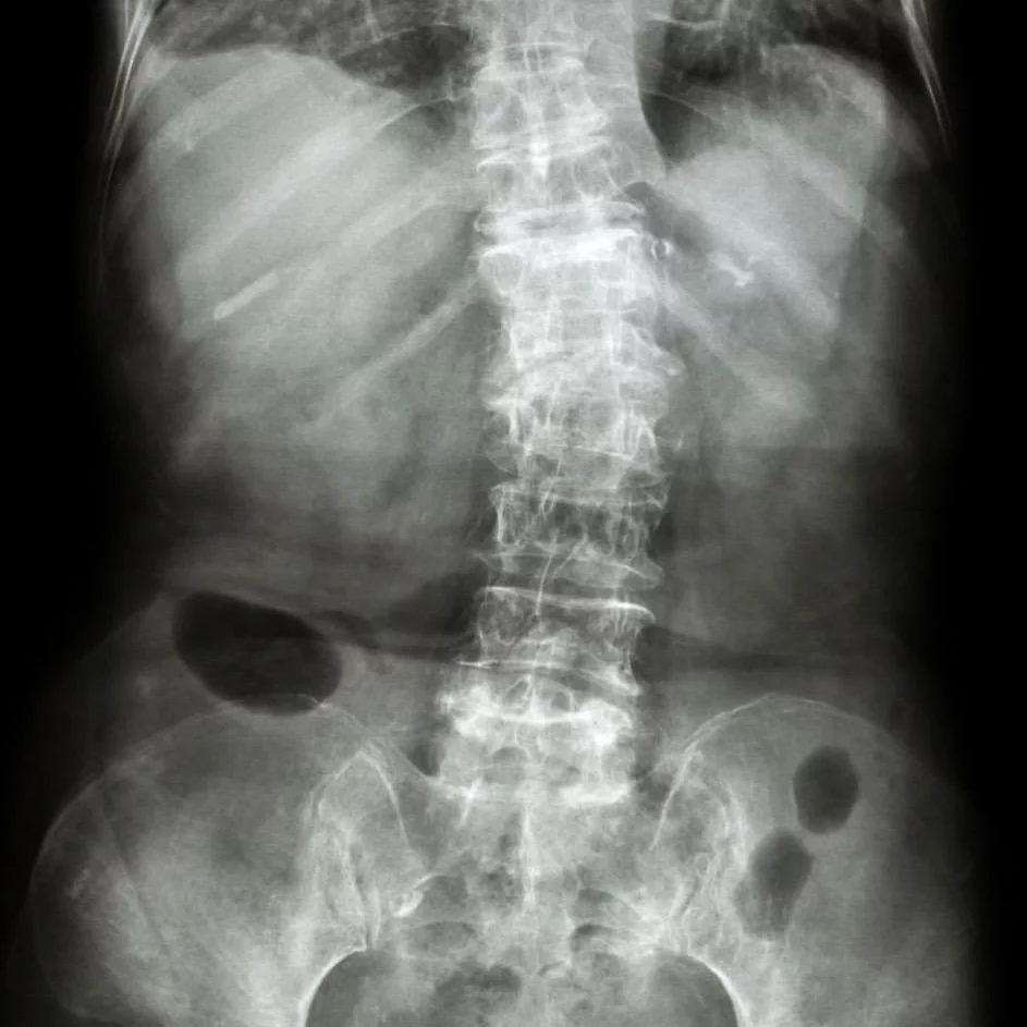 Escoliosis degenerativa