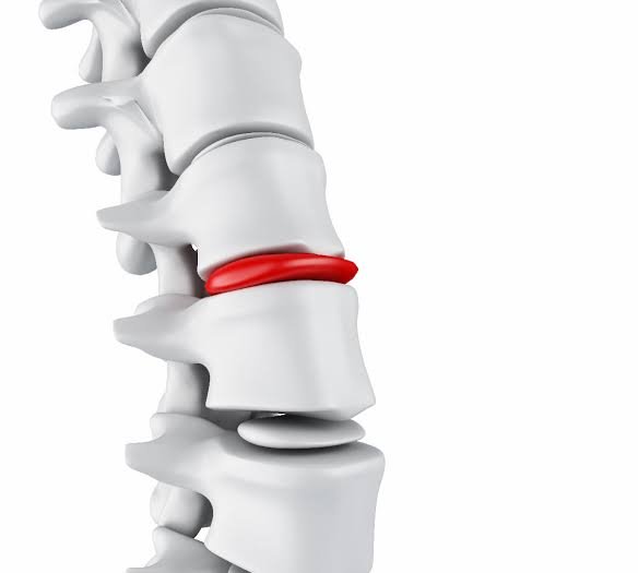 Tratamiento hernias discales en Barcelona