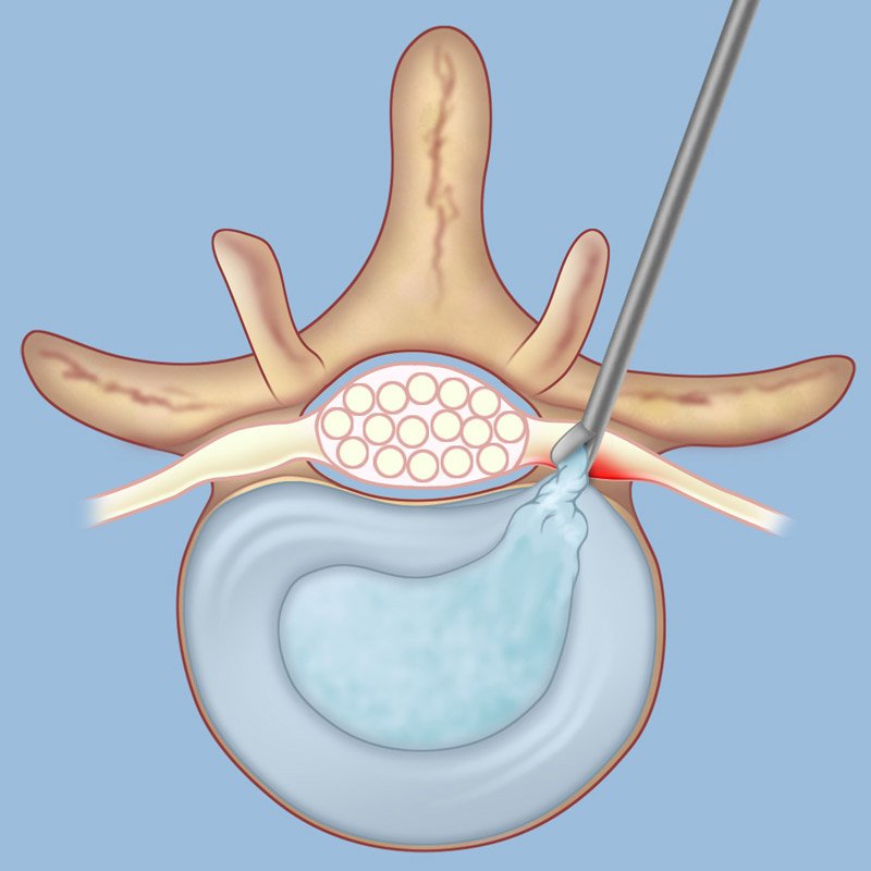 Microcirugía lumbar y cervical